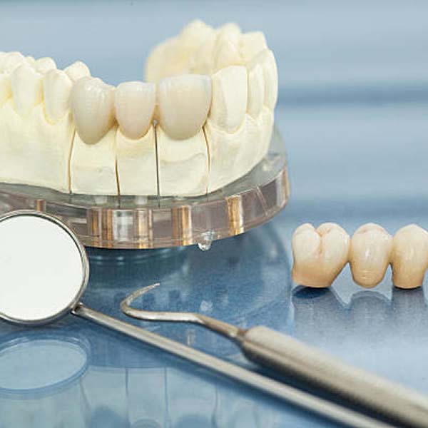 Dental Crowns and Bridges Restoration
