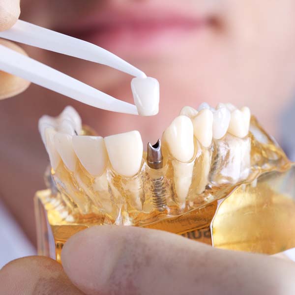 Dental Implants and 3D Guided Surgical Placement