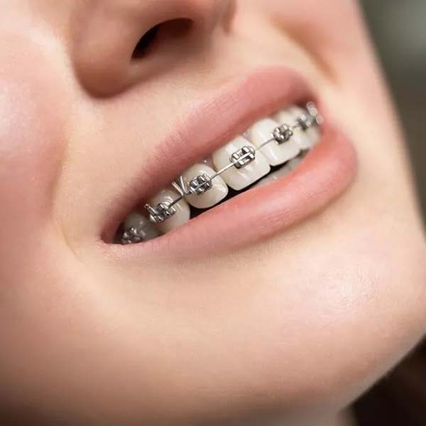 Orthodontics and Clear Invisalign Aligners